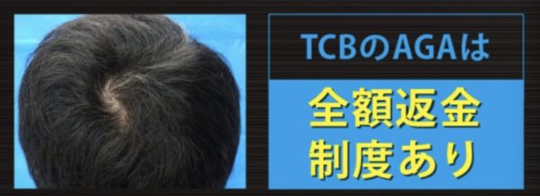 TCB東京中央美容外科　AGA