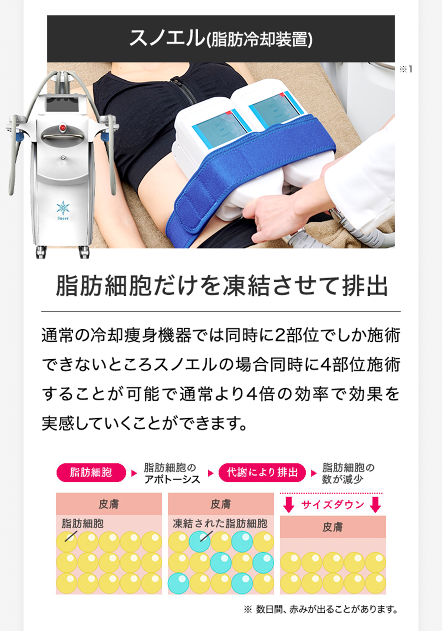 スノエル（脂肪冷却装置）