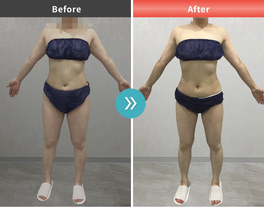 医療痩身・医療ダイエットの症例No.0043｜61.0kg→53.3kg（40代女性・155cm）