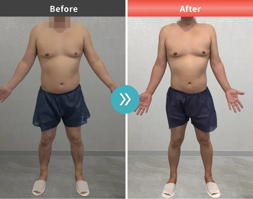 医療痩身・医療ダイエットの症例No.0045｜83.3kg→77.7kg（50代男性・174cm）