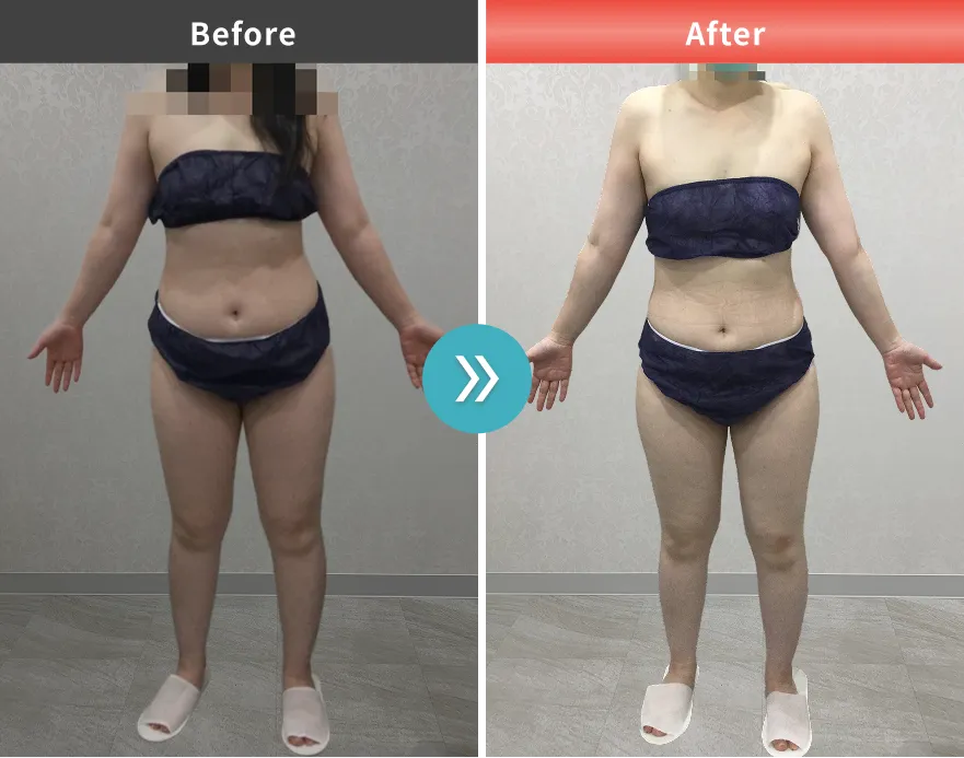 医療痩身・医療ダイエットの症例No.0046｜65.2kg→59.8kg（40代女性・157cm）