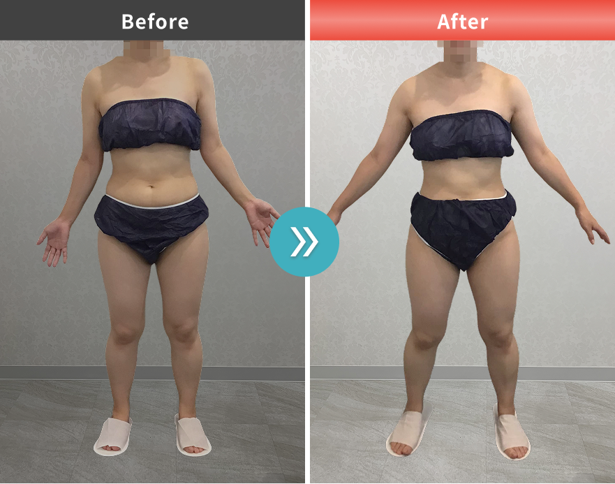 医療痩身・医療ダイエットの症例No.0075｜50.8kg→45.9kg（20代女性・146cm）