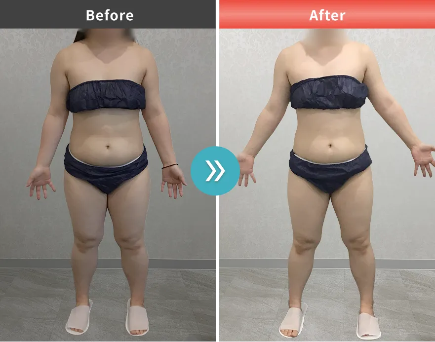 医療痩身・医療ダイエットの症例No.0084｜70.7kg→60.6kg（20代女性・154cm）