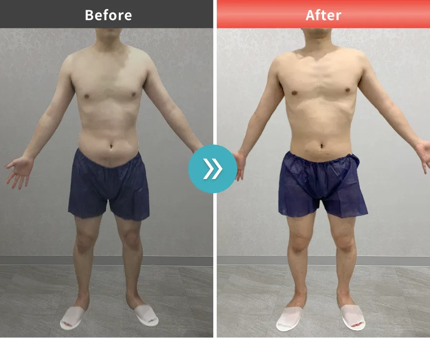 医療痩身・医療ダイエットの症例No.0041｜81.1kg→73.9kg（30代男性・177cm）