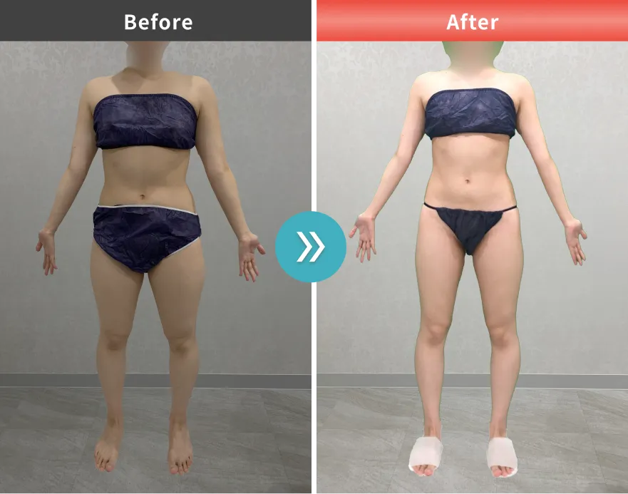 医療痩身・医療ダイエットの症例No.0006｜61kg→51.5kg（20代女性・160cm）