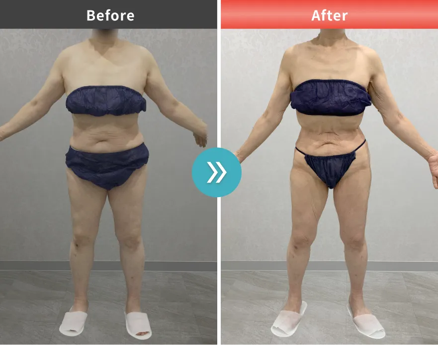 医療痩身・医療ダイエットの症例No.0071｜57.3kg→47.7kg（50代女性・155.5cm）