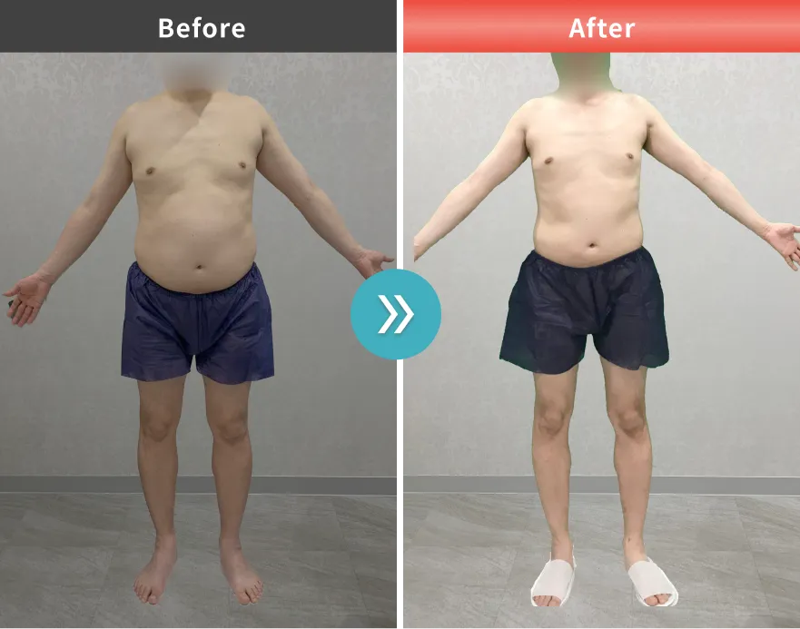 痩身・医療ダイエットの症例No.0007｜83.5kg→72kg（40代男性・173cm）