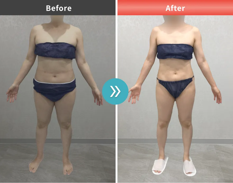 医療痩身・医療ダイエットの症例No.0008｜60kg→51.9kg（40代女性・156cm）