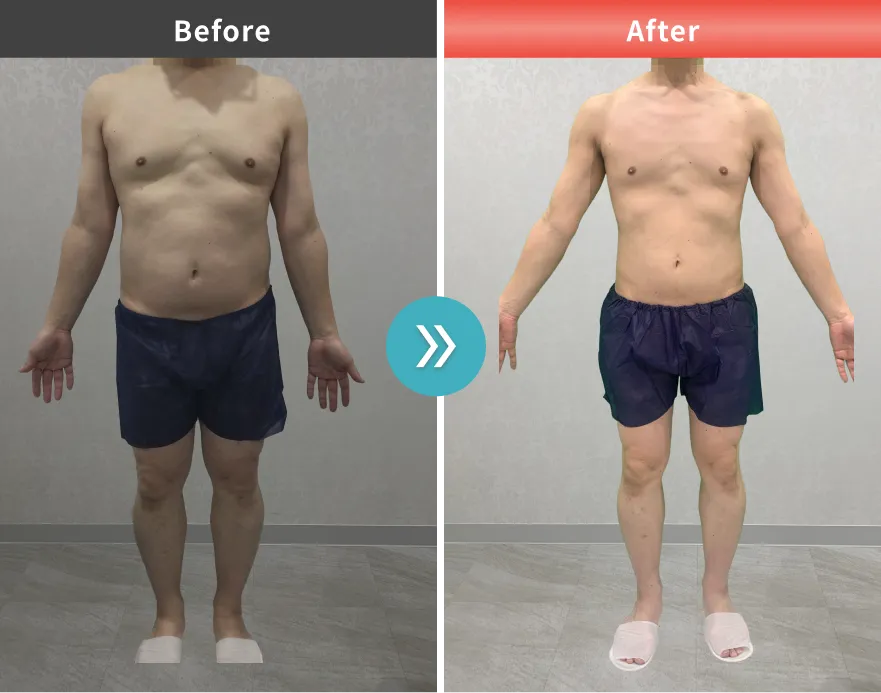 医療痩身・医療ダイエットの症例No.0005｜96.1kg→75.8kg（40代男性・176cm）