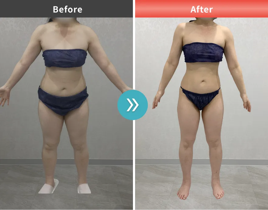 医療痩身・医療ダイエットの症例No.0072｜59.9kg→53.0kg（50代女性・156cm）