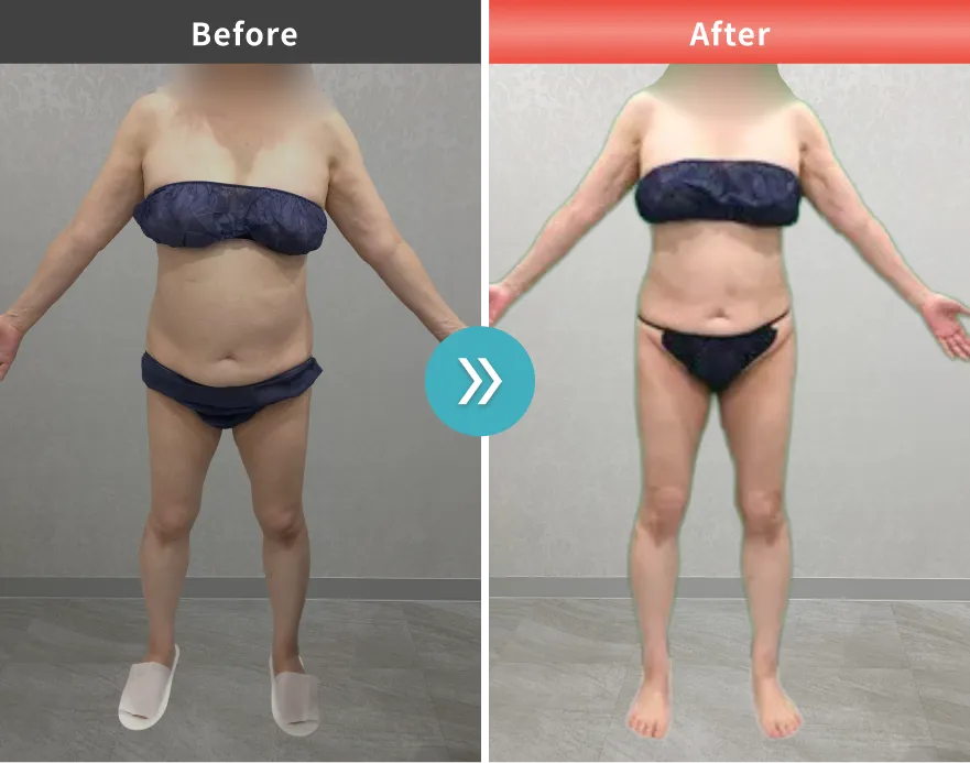 医療痩身・医療ダイエットの症例No.00101｜65.7kg→60.0kg（50代女性・161cm）