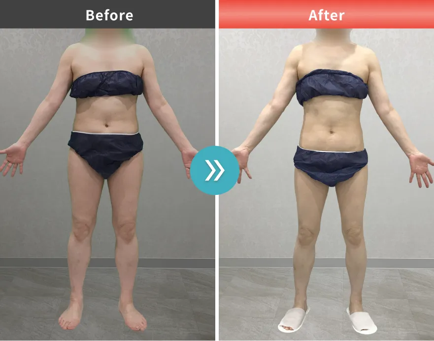 医療痩身・医療ダイエットの症例No.00102｜63.4kg→52.9kg（50代女性・162cm）