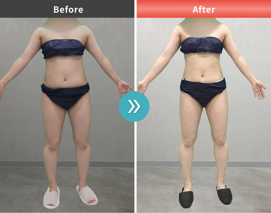 医療痩身・医療ダイエットの症例No.00106｜64.7kg→57.0kg（30代女性・159cm）