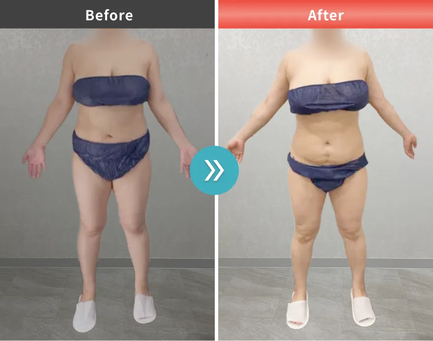 医療痩身・医療ダイエットの症例No.00109｜66.9kg→62.9kg（40代女性・154cm）