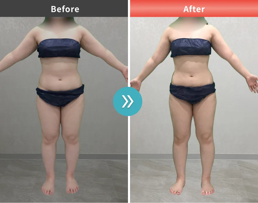 医療痩身・医療ダイエットの症例No.00112｜68.6kg→60.7kg（30代女性・157cm）