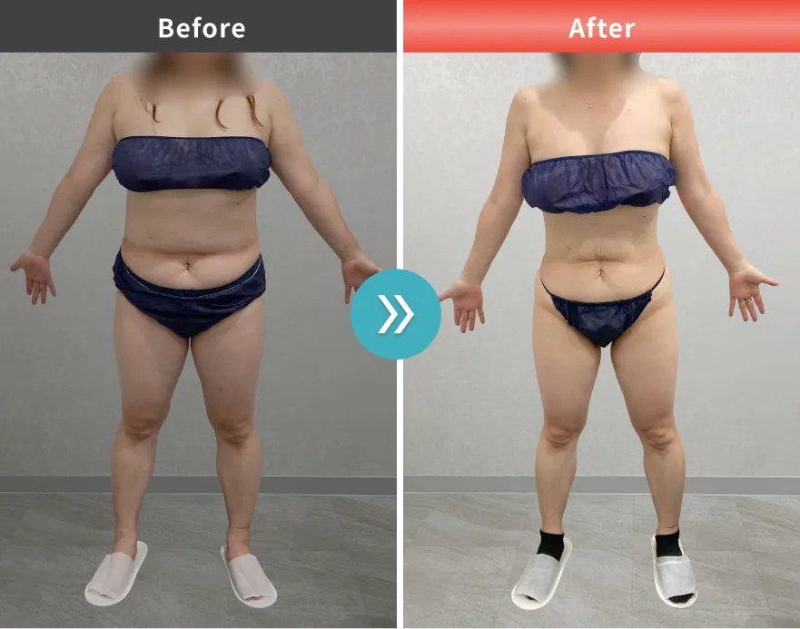 医療痩身・医療ダイエットの症例No.00113｜69.4kg→54.8kg（50代女性・156.5cm）