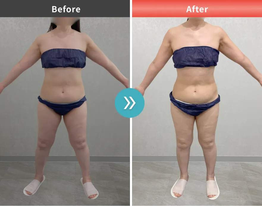 医療痩身・医療ダイエットの症例No.00114｜69.5kg→62.5kg（50代女性・161cm）