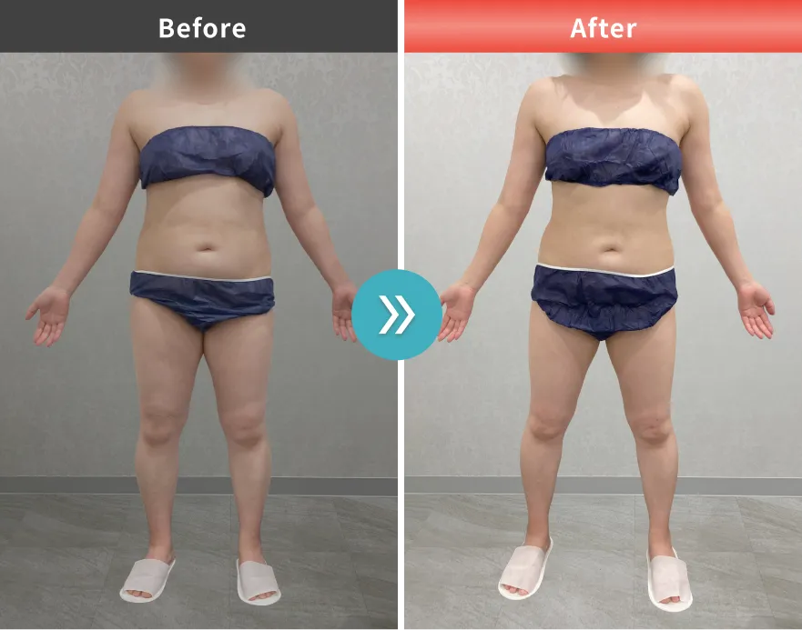 医療痩身・医療ダイエットの症例No.00115｜70.2kg→61.3kg（40代女性・159cm）