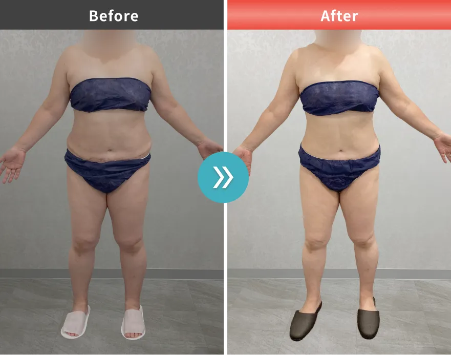 医療痩身・医療ダイエットの症例No.00117｜72.0kg→65.3kg（50代女性・158cm）
