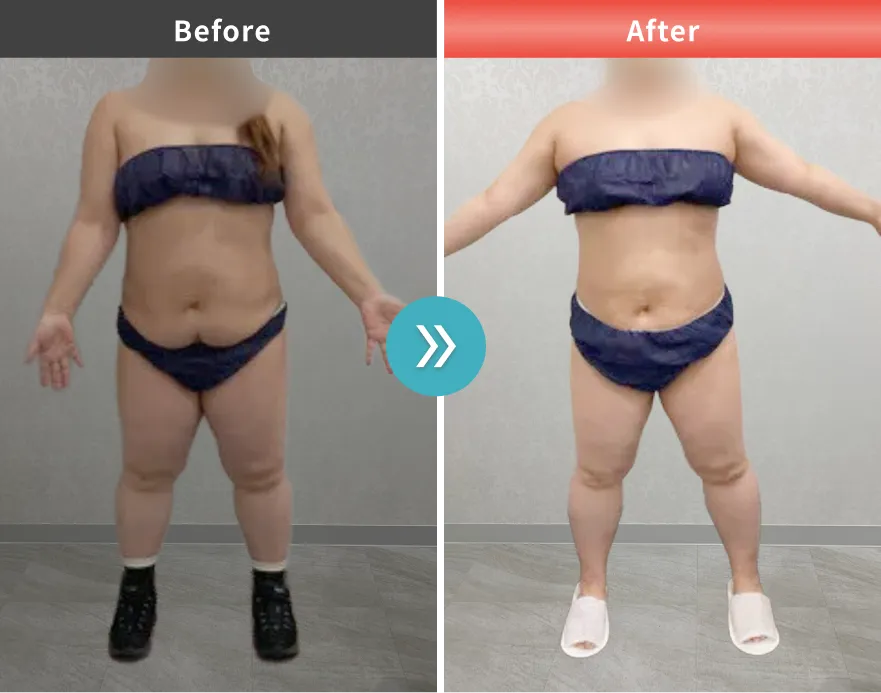 医療痩身・医療ダイエットの症例No.00118｜72.2kg→69.2kg（40代女性・148cm）