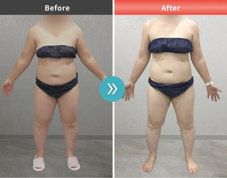 医療痩身・医療ダイエットの症例No.00131｜82.4kg→74.0kg（30代女性・159cm）