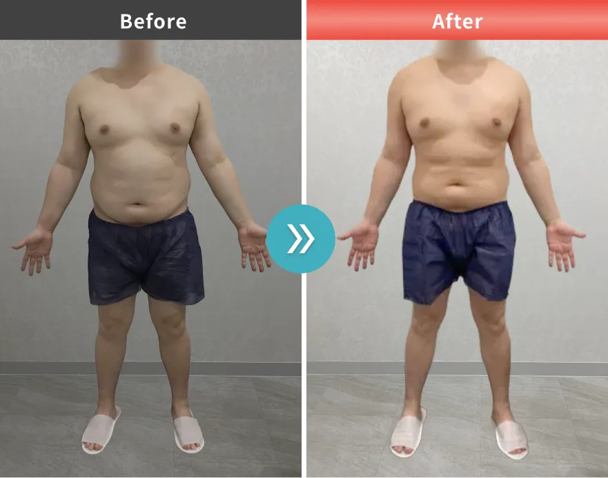 医療痩身・医療ダイエットの症例No.00133｜83.6kg→77.0kg（30代男性・165cm）