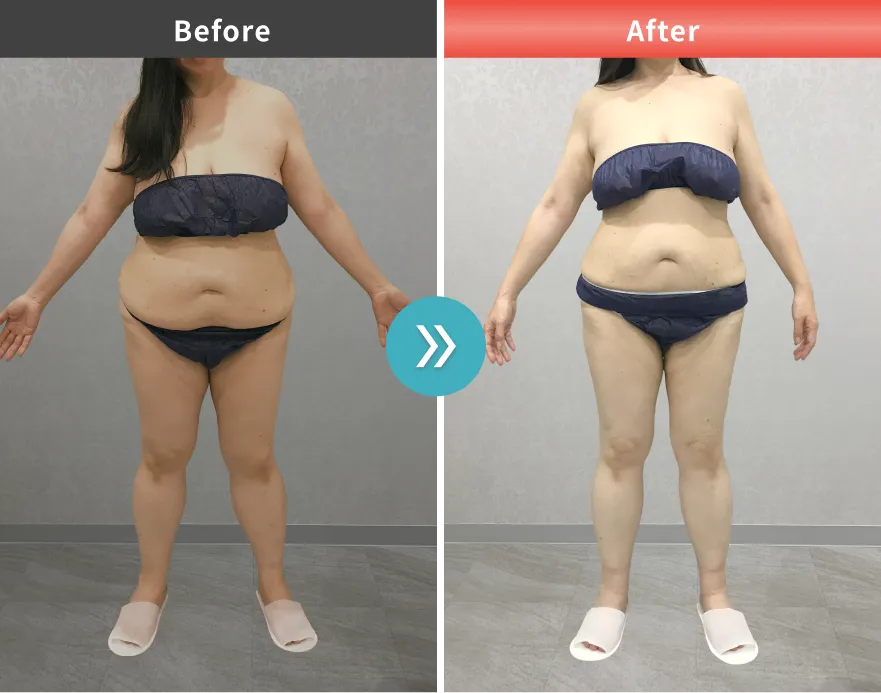 医療痩身・医療ダイエットの症例No.00134｜83.7kg→72.0kg（50代女性・161cm）