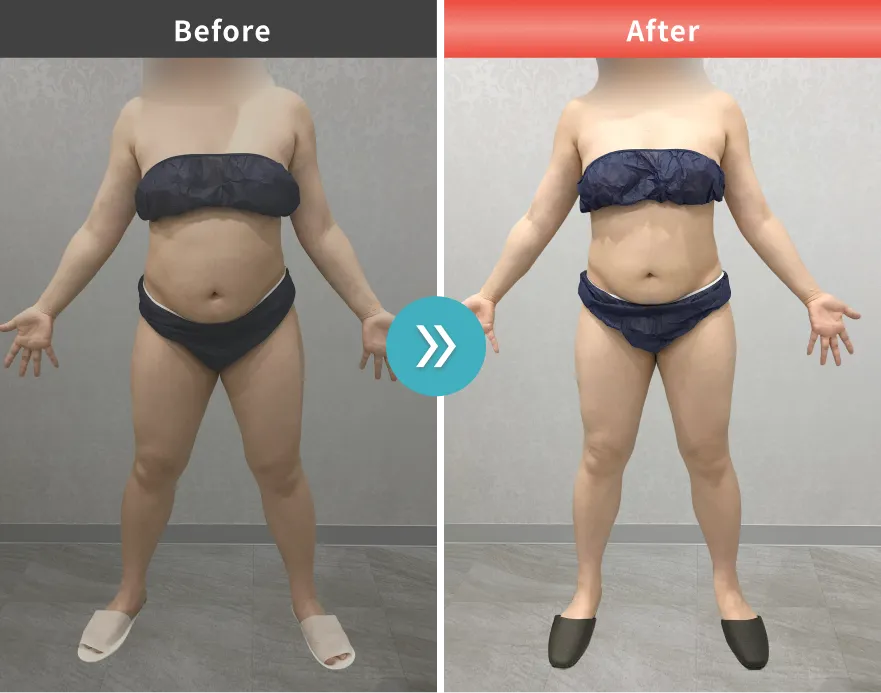 医療痩身・医療ダイエットの症例No.00135｜83.8kg→76.1kg（30代女性・168cm）