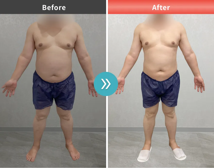 医療痩身・医療ダイエットの症例No.00136｜83.9kg→76.1kg（50代男性・163cm）