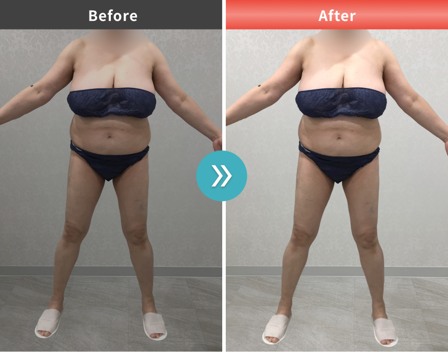 医療痩身・医療ダイエットの症例No.00137｜84.0kg→73.9kg（50代女性・170cm）