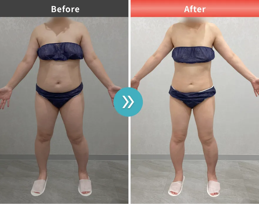 医療痩身・医療ダイエットの症例No.00138｜85.1kg→71.3kg（40代女性・169cm）