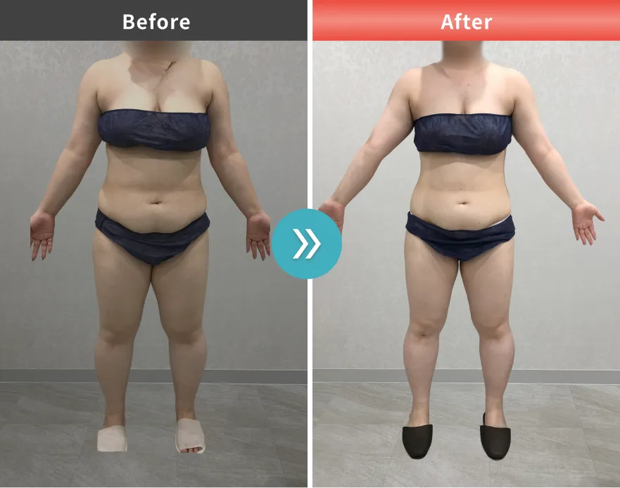 医療痩身・医療ダイエットの症例No.00141｜85.3kg→76.7kg（20代女性・163cm）
