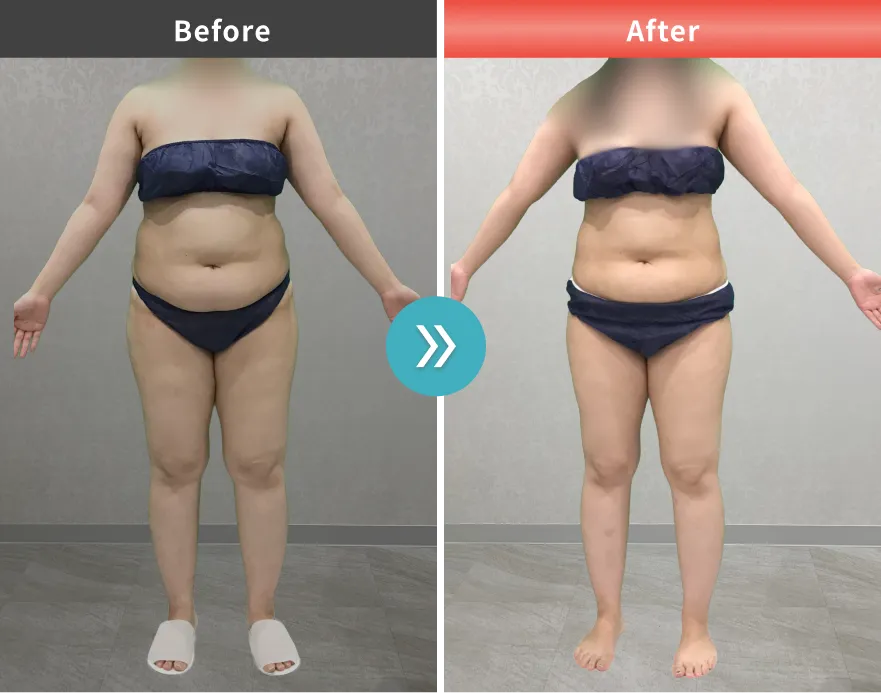 医療痩身・医療ダイエットの症例No.00144｜85.9kg→74.0kg（20代女性・166cm）