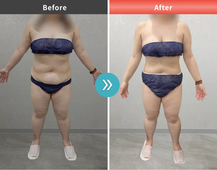 医療痩身・医療ダイエットの症例No.00147｜86.9kg→77.1kg（30代女性・162cm）