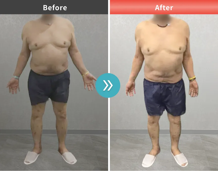 医療痩身・医療ダイエットの症例No.00148｜87.4kg→79.0kg（70代男性・163cm）