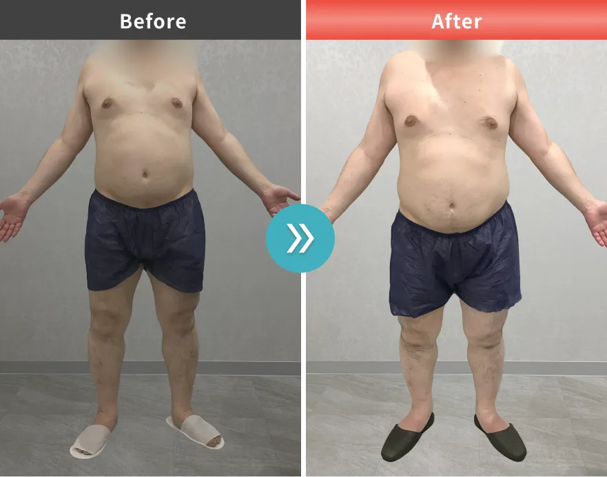 医療痩身・医療ダイエットの症例No.00149｜88.4kg→81.2kg（40代男性・166cm）