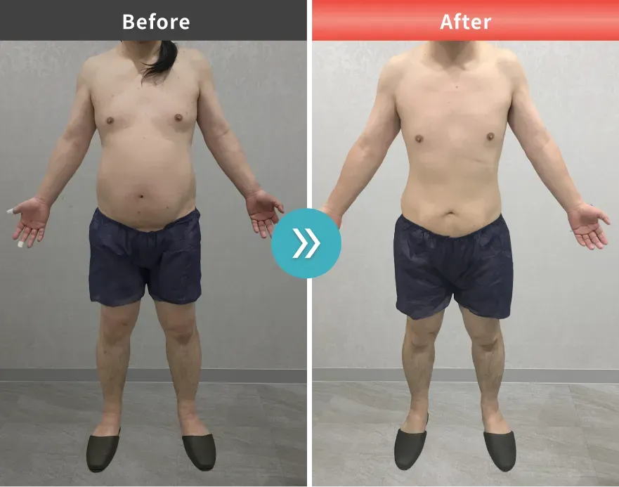医療痩身・医療ダイエットの症例No.00150｜89.3kg→77.6kg（40代男性・169cm）