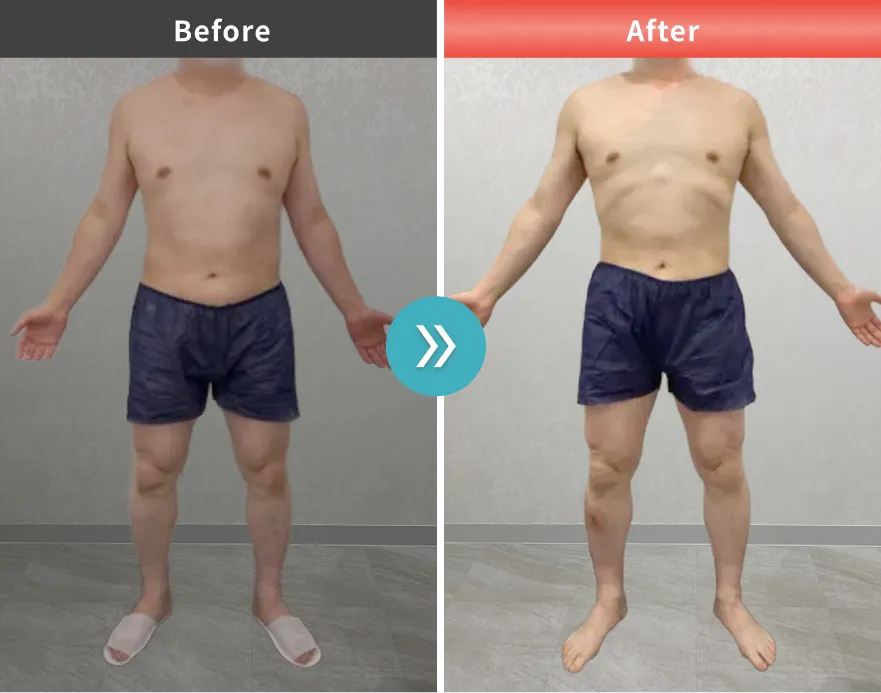 医療痩身・医療ダイエットの症例No.00153｜89.8kg→81.7kg（50代男性・174cm）