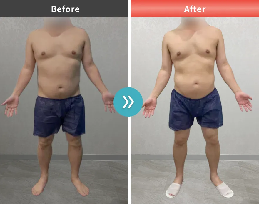 医療痩身・医療ダイエットの症例No.00155｜91.9kg→84.4kg（30代男性・172cm）