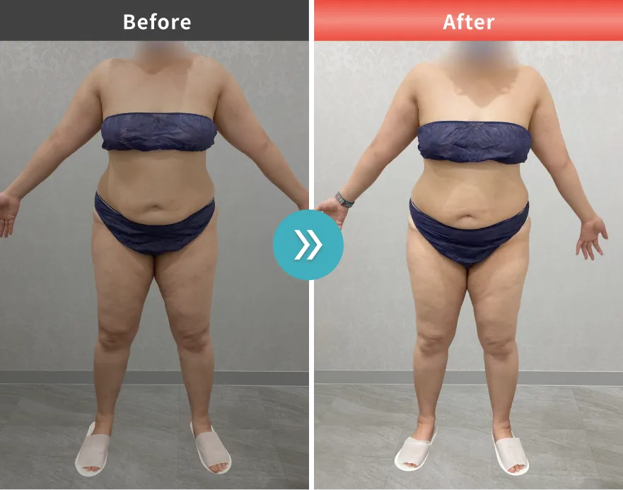 医療痩身・医療ダイエットの症例No.00156｜92.2kg→84.7kg（40代女性・167cm）