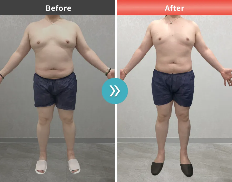 医療痩身・医療ダイエットの症例No.00157｜93.6kg→87.1kg（40代男性・171cm）
