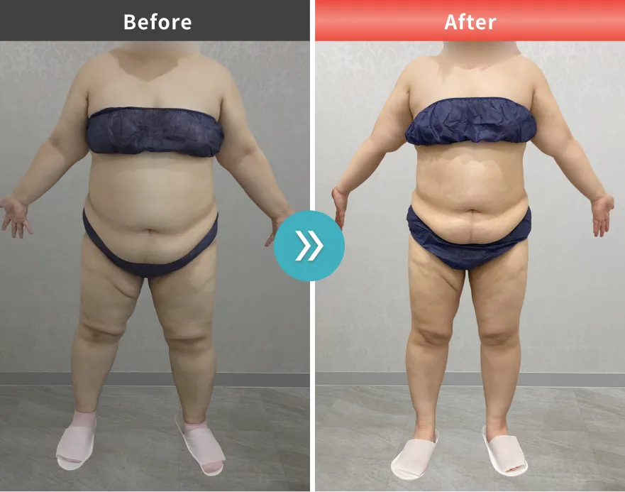 医療痩身・医療ダイエットの症例No.00158｜93.7kg→76.7kg（30代女性・153cm）