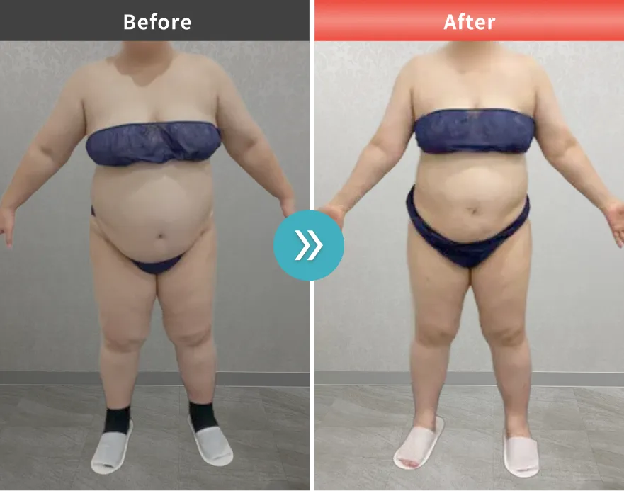 医療痩身・医療ダイエットの症例No.00159｜93.9kg→77.9kg（50代女性・153cm）