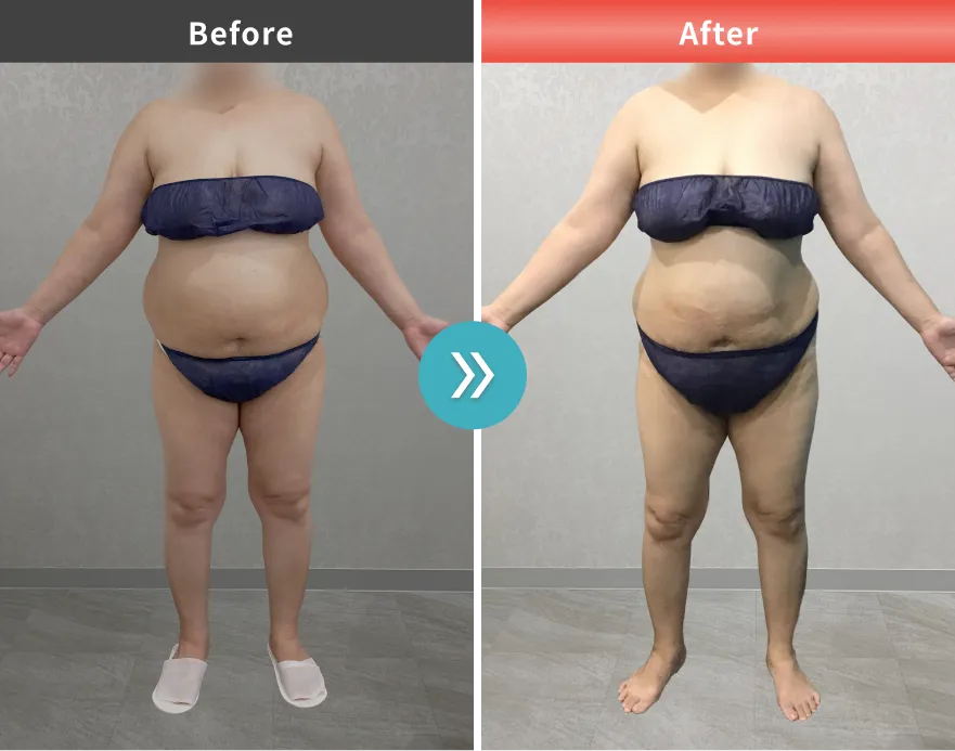 医療痩身・医療ダイエットの症例No.00160｜95.2kg→86.0kg（50代女性・165cm）