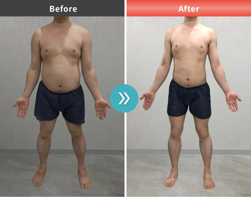 医療痩身・医療ダイエットの症例No.00161｜95.4kg→77.7kg（30代男性・178cm）