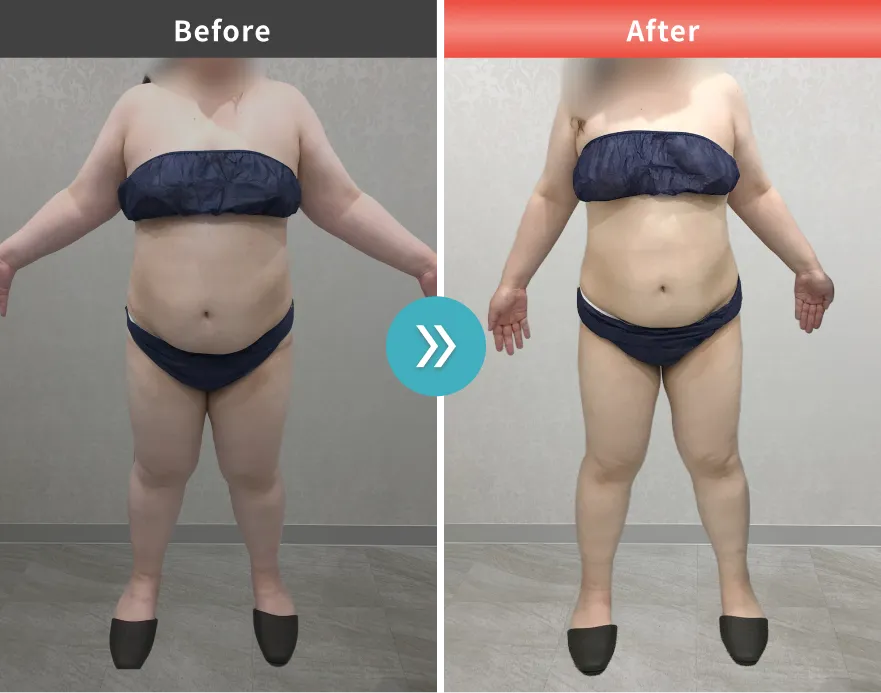 医療痩身・医療ダイエットの症例No.00162｜95.8kg→85.0kg（30代女性・160cm）