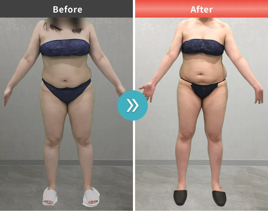 医療痩身・医療ダイエットの症例No.00163｜96.6kg→88.6kg（30代女性・170cm）