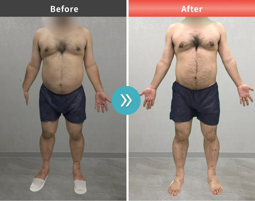 医療痩身・医療ダイエットの症例No.00164｜105.1kg→93.3kg（30代男性・171cm）