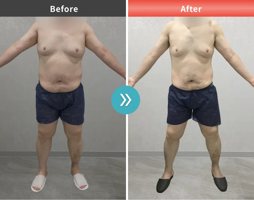 医療痩身・医療ダイエットの症例No.00165｜99.3kg→89.3kg（40代男性・172cm）