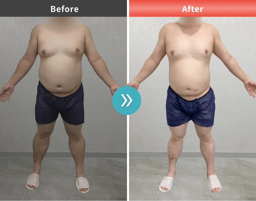 医療痩身・医療ダイエットの症例No.00166｜100.6kg→90.1kg（30代男性・172cm）